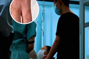 酪氨酸酶的作用與功效及副作用